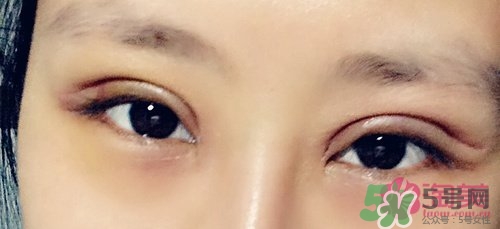 切開雙眼皮多久消腫？切開雙眼皮多久恢復(fù)？