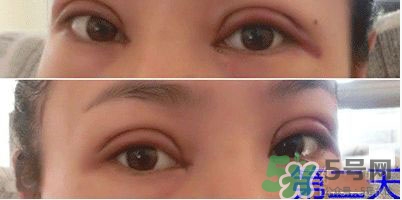 定點(diǎn)雙眼皮恢復(fù)過(guò)程圖_定點(diǎn)雙眼皮要多久恢復(fù) 定點(diǎn)雙眼皮恢復(fù)過(guò)程圖_定點(diǎn)雙眼皮要多久恢復(fù)