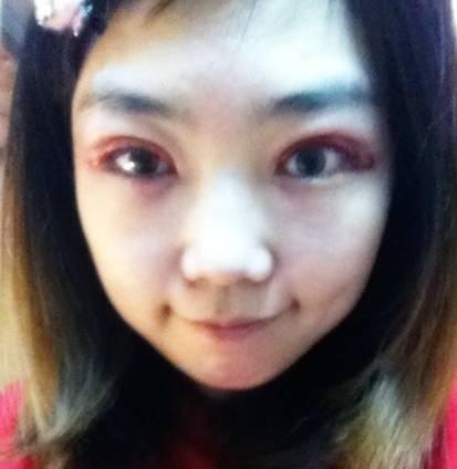 韓式三點(diǎn)雙眼皮是永久嗎？三點(diǎn)雙眼皮能保持多久？