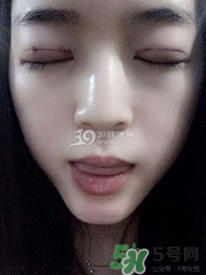 什么是定點雙眼皮？定點雙眼皮多少錢？