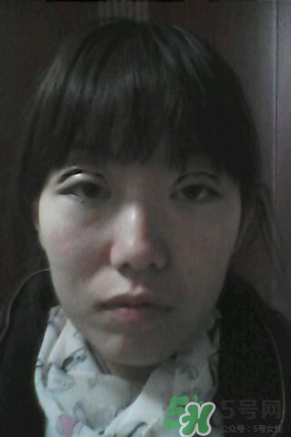 什么是定點雙眼皮？定點雙眼皮多少錢？