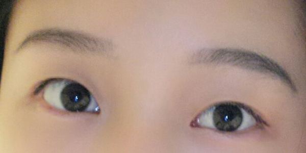 定點(diǎn)雙眼皮恢復(fù)過(guò)程圖_定點(diǎn)雙眼皮要多久恢復(fù) 定點(diǎn)雙眼皮恢復(fù)過(guò)程圖_定點(diǎn)雙眼皮要多久恢復(fù)