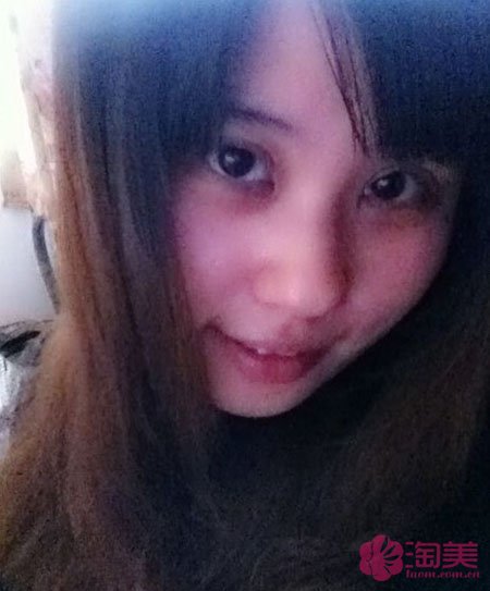 三點雙眼皮恢復過程圖_韓式三點雙眼皮多久恢復自然