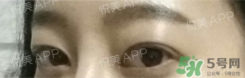 埋線雙眼皮多久恢復(fù)自然？埋線雙眼皮多久能恢復(fù)
