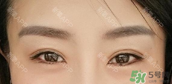 埋線雙眼皮能保持多久？埋線雙眼皮是永久嗎