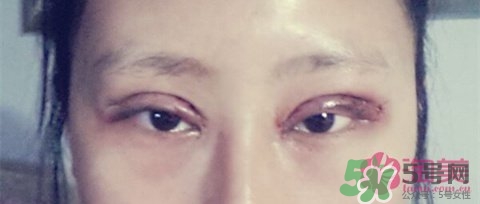 切開雙眼皮多久消腫？切開雙眼皮多久恢復(fù)？