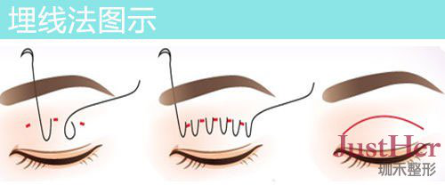 定點(diǎn)雙眼皮怎么做？定點(diǎn)雙眼皮需要拆線嗎？