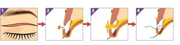 定點(diǎn)雙眼皮怎么做？定點(diǎn)雙眼皮需要拆線嗎？