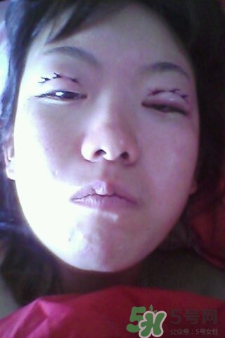 什么是定點雙眼皮？定點雙眼皮多少錢？