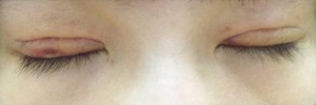 韓式三點(diǎn)雙眼皮是永久嗎？三點(diǎn)雙眼皮能保持多久？