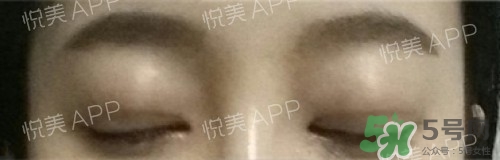 埋線雙眼皮多久恢復(fù)自然？埋線雙眼皮多久能恢復(fù)