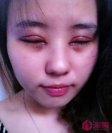 三點雙眼皮恢復過程圖_韓式三點雙眼皮多久恢復自然