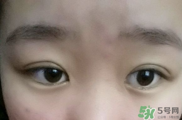 埋線雙眼皮需要拆線嗎？埋線雙眼皮怎么拆線