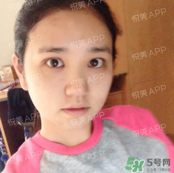 埋線雙眼皮的危害_埋線雙眼皮有風險后遺癥嗎