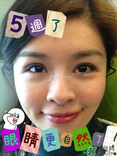 重瞼術是什么？重瞼術是永久的嗎？