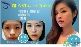 重瞼術是什么？重瞼術是永久的嗎？