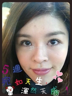 重瞼術是什么？重瞼術是永久的嗎？