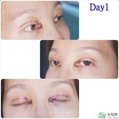 重瞼術(shù)多久能完全消腫 重瞼術(shù)恢復(fù)過程圖 重瞼術(shù)多久能完全消腫 重瞼術(shù)恢復(fù)過程圖