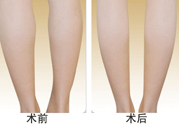 小腿吸脂多久見效？小腿吸脂后多久能看見效果？