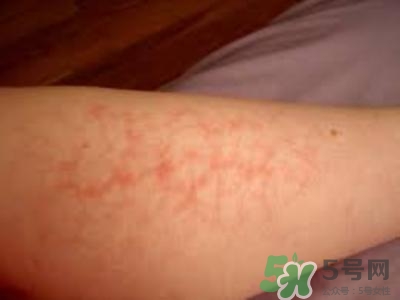 腿上有血絲是怎么回事?腿上有血絲怎么消除 腿上有血絲是怎么回事?腿上有血絲怎么消除