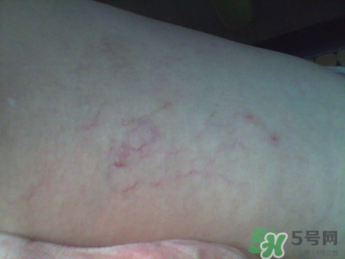 腿上有血絲是怎么回事?腿上有血絲怎么消除 腿上有血絲是怎么回事?腿上有血絲怎么消除