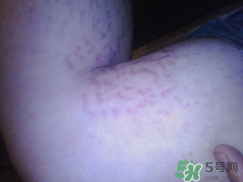 腿上有血絲是怎么回事?腿上有血絲怎么消除 腿上有血絲是怎么回事?腿上有血絲怎么消除