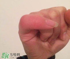 小拇指凍腫了怎么辦？為什么小拇指容易凍？