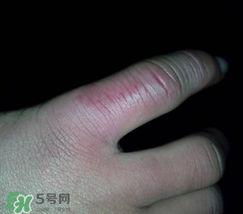 小拇指凍腫了怎么辦？為什么小拇指容易凍？