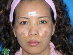 藏紅花能去黃褐斑嗎?怎么去黃褐斑最有效 藏紅花能去黃褐斑嗎?怎么去黃褐斑最有效