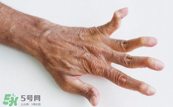 類風(fēng)濕性關(guān)節(jié)炎可以治愈嗎?類風(fēng)濕性關(guān)節(jié)炎能根治嗎? 類風(fēng)濕性關(guān)節(jié)炎可以治愈嗎?類風(fēng)濕性關(guān)節(jié)炎能根治嗎?