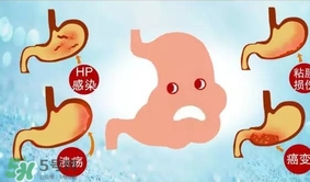 神經(jīng)性胃痙攣是什么？神經(jīng)性胃痙攣是什么原因？