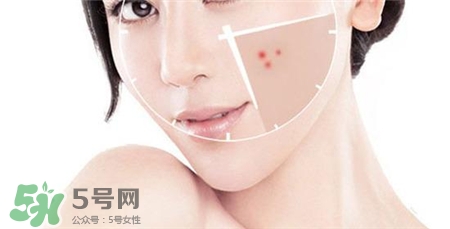 熱敷臉可以祛痘嗎?熱敷臉祛痘好嗎? 熱敷臉可以祛痘嗎?熱敷臉祛痘好嗎?