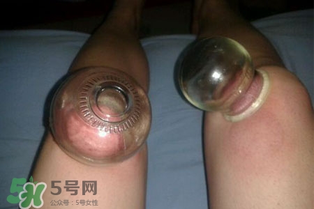 小腿能拔罐嗎？在小腿上拔火罐有什么作用？