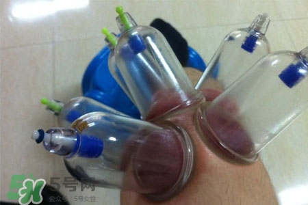 小腿能拔罐嗎？在小腿上拔火罐有什么作用？