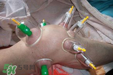 小腿能拔罐嗎？在小腿上拔火罐有什么作用？