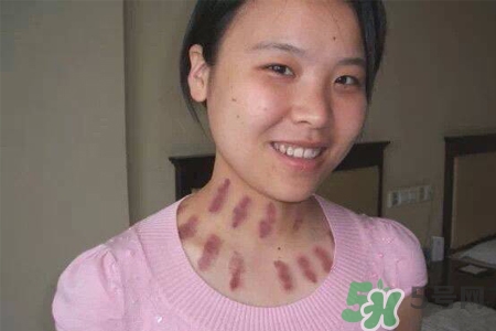 刮痧分季節(jié)嗎？刮痧什么季節(jié)最好？