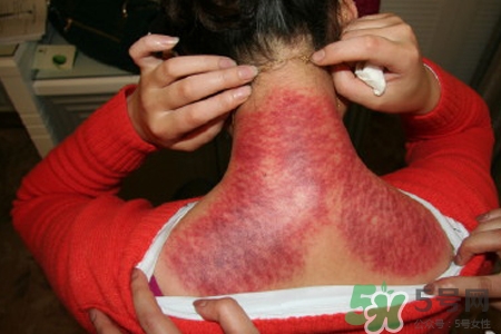 刮痧可以治頸椎病嗎？刮痧能治療頸椎病嗎？