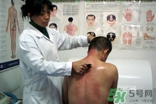 刮痧可以減肥嗎？刮痧減肥有效果嗎？