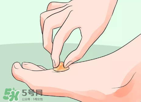 水泡怎么處理？水泡要不要刺破？