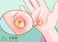 水泡怎么處理？水泡要不要刺破？