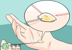 水泡怎么處理？水泡要不要刺破？