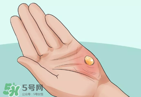 水泡怎么處理？水泡要不要刺破？