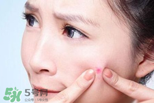 上火長痘痘吃什么排毒?上火長痘痘吃什么好? 上火長痘痘吃什么排毒?上火長痘痘吃什么好?