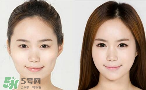 瘦臉針分為幾種類型？瘦臉針有哪幾個(gè)牌子？