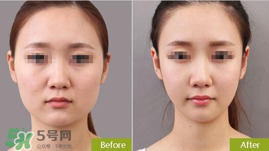 瘦臉針分為幾種類型？瘦臉針有哪幾個(gè)牌子？