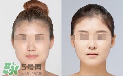 瘦臉針分為幾種類型？瘦臉針有哪幾個(gè)牌子？