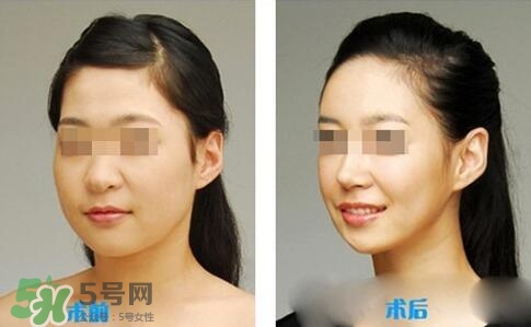 瘦臉針分為幾種類型？瘦臉針有哪幾個(gè)牌子？