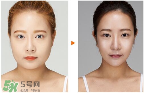 瘦臉針分為幾種類型？瘦臉針有哪幾個(gè)牌子？