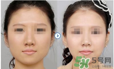 打瘦臉針疼不疼？打瘦臉針的注意事項