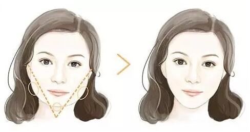 瘦臉針適合什么人打？瘦臉針適合什么臉型？